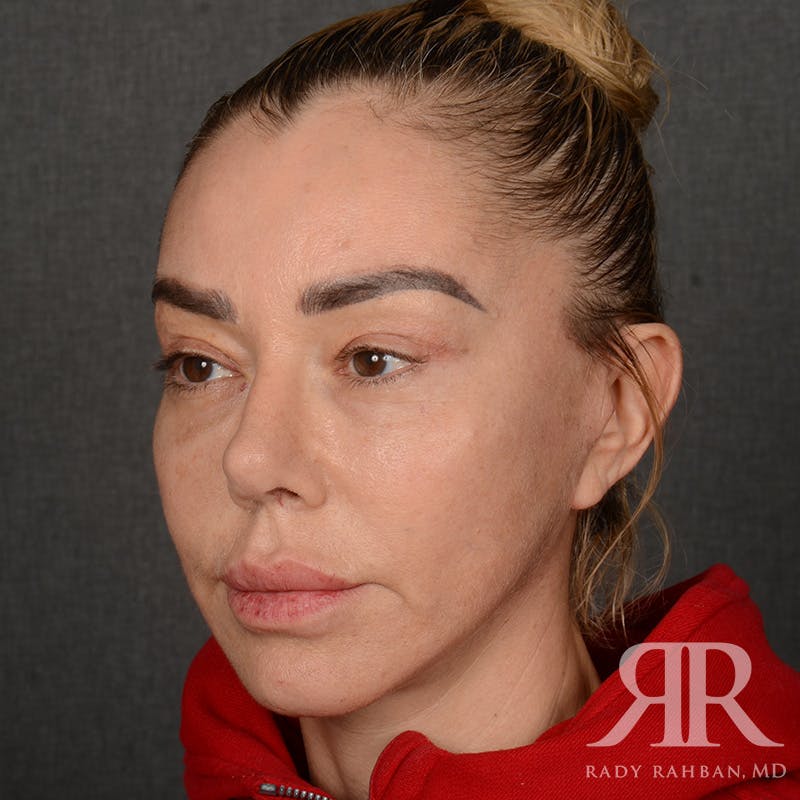 Facelift Before & After Gallery - Patient 399939 - Image 4