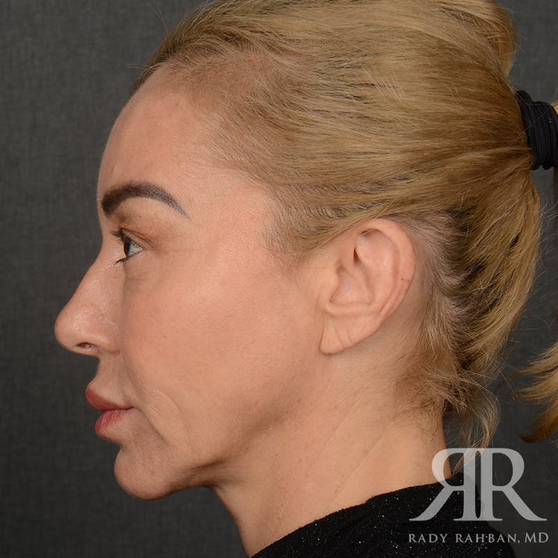 Facelift Before & After Gallery - Patient 399939 - Image 5