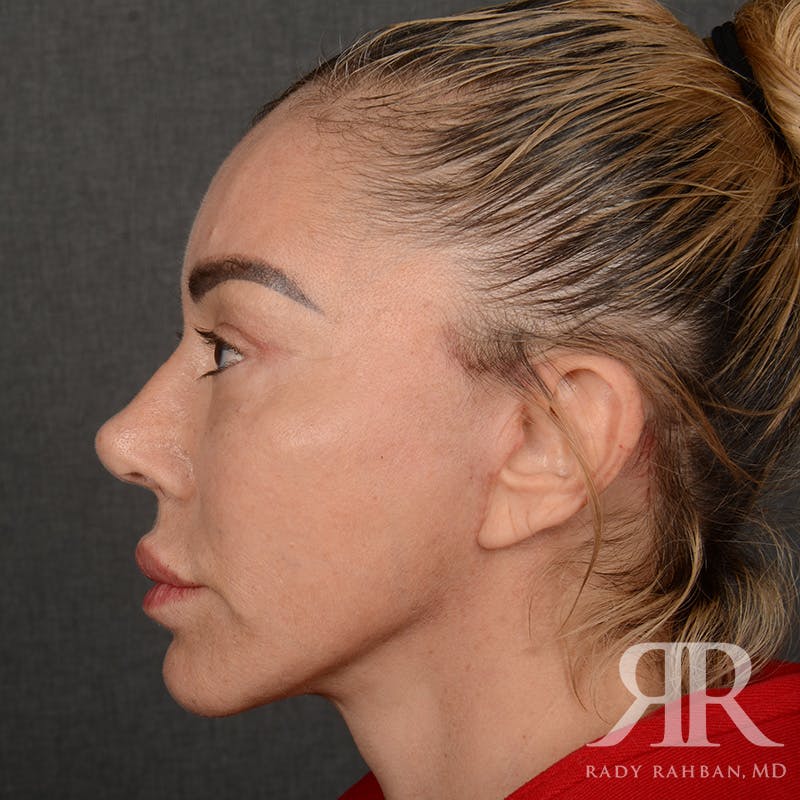 Facelift Before & After Gallery - Patient 399939 - Image 6