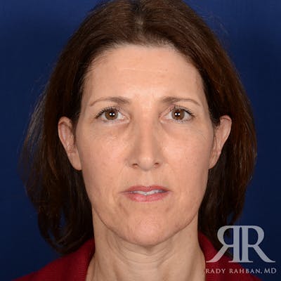 Facelift Before & After Gallery - Patient 107924 - Image 1