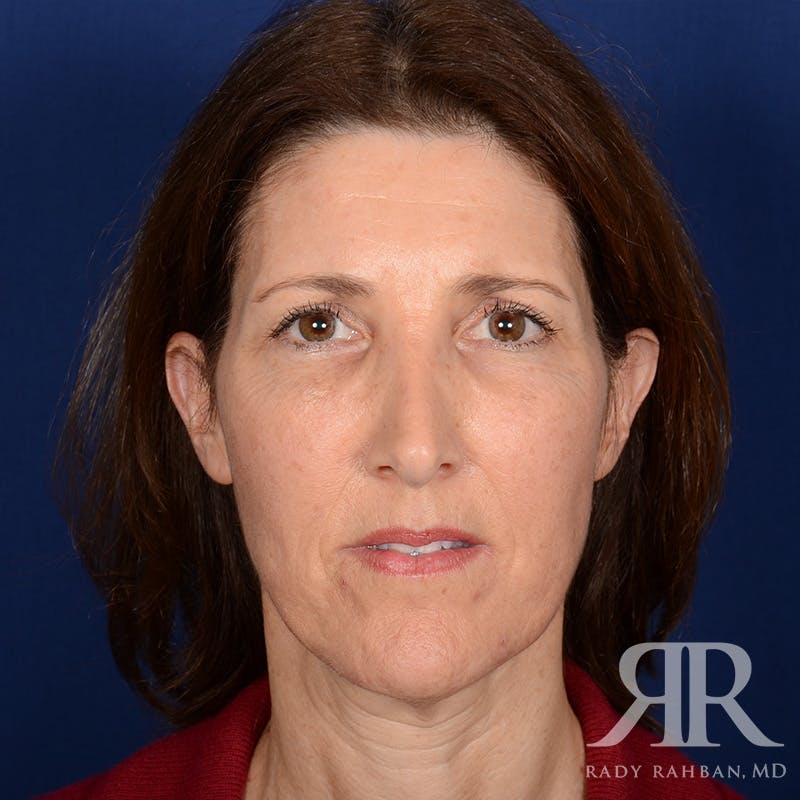 Facelift Before & After Gallery - Patient 107924 - Image 1