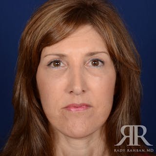 Facelift Before & After Gallery - Patient 107924 - Image 2