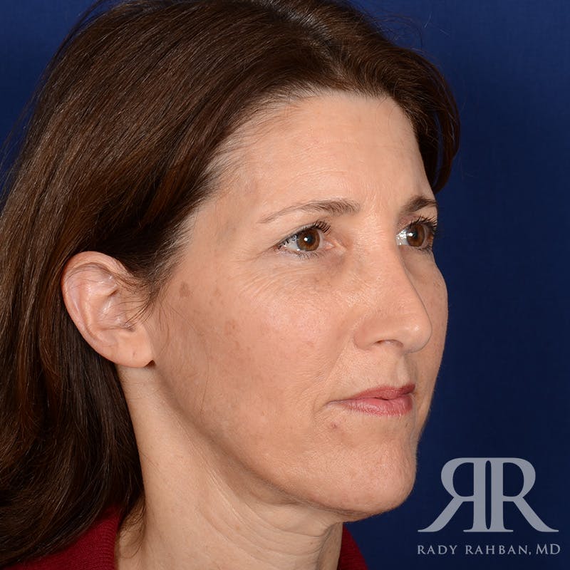 Facelift Before & After Gallery - Patient 107924 - Image 3