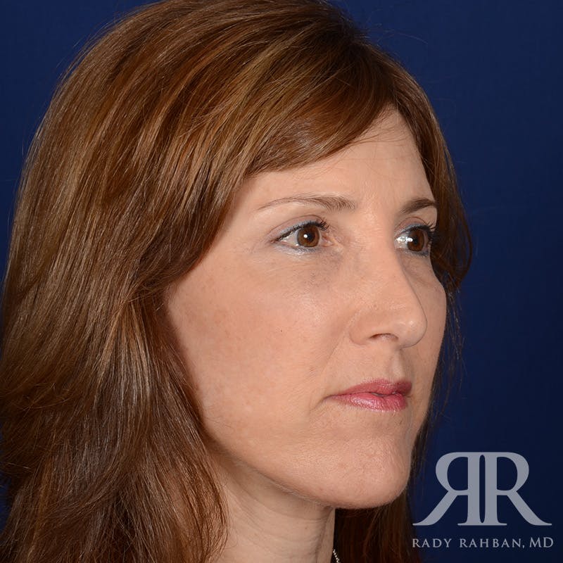 Facelift Before & After Gallery - Patient 107924 - Image 4