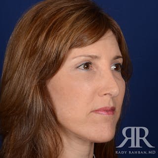 Facelift Before & After Gallery - Patient 107924 - Image 4