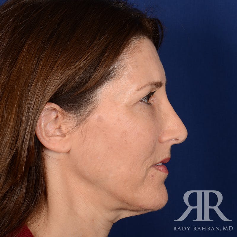 Facelift Before & After Gallery - Patient 107924 - Image 5