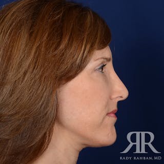 Facelift Before & After Gallery - Patient 107924 - Image 6