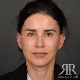 Facelift Before & After Gallery - Patient 175356 - Image 2