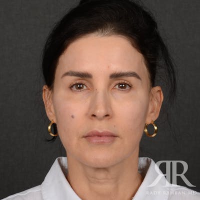 Facelift Before & After Gallery - Patient 175356 - Image 1