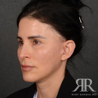 Facelift Before & After Gallery - Patient 175356 - Image 4