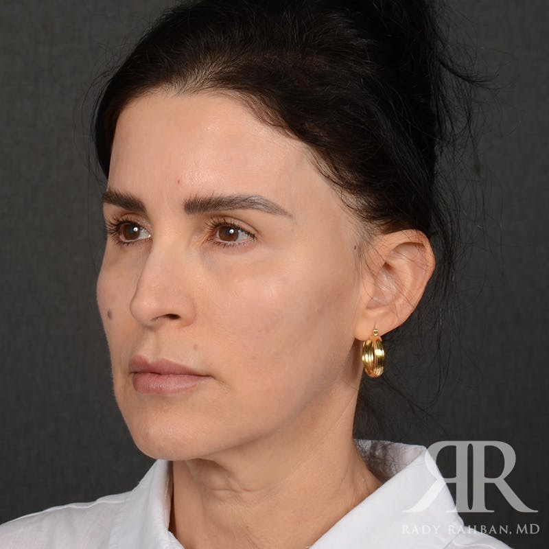 Facelift Before & After Gallery - Patient 175356 - Image 3