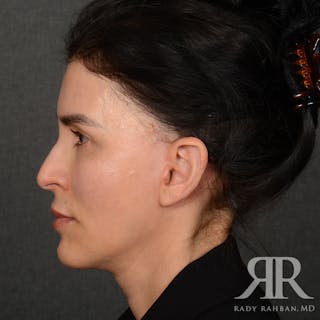 Facelift Before & After Gallery - Patient 175356 - Image 6