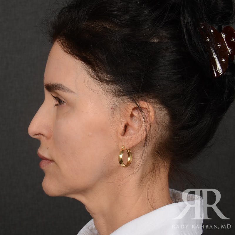 Facelift Before & After Gallery - Patient 175356 - Image 5