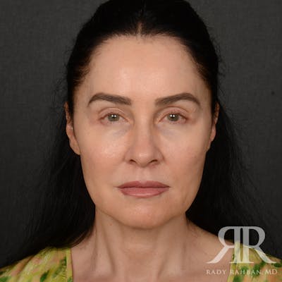 Facelift Before & After Gallery - Patient 387394 - Image 1