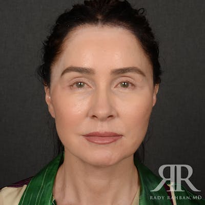 Facelift Before & After Gallery - Patient 387394 - Image 2