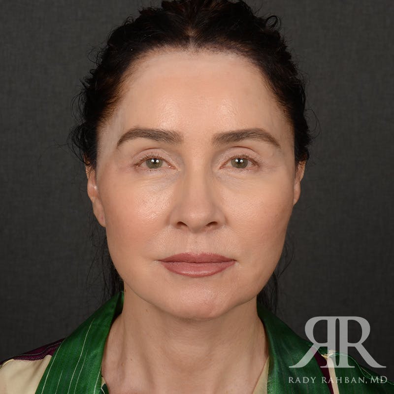 Before and after patient results