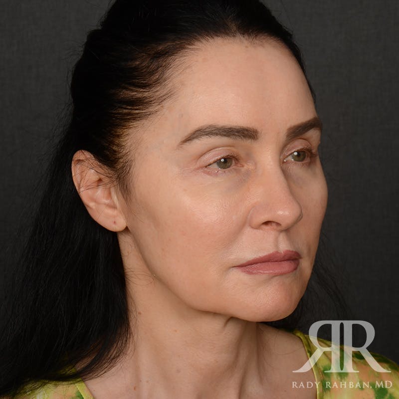Facelift Before & After Gallery - Patient 387394 - Image 3