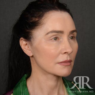 Facelift Before & After Gallery - Patient 387394 - Image 4