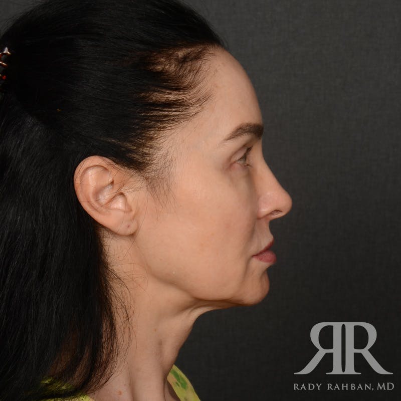 Facelift Before & After Gallery - Patient 387394 - Image 5