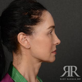Facelift Before & After Gallery - Patient 387394 - Image 6