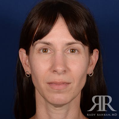Facelift Before & After Gallery - Patient 165852 - Image 1