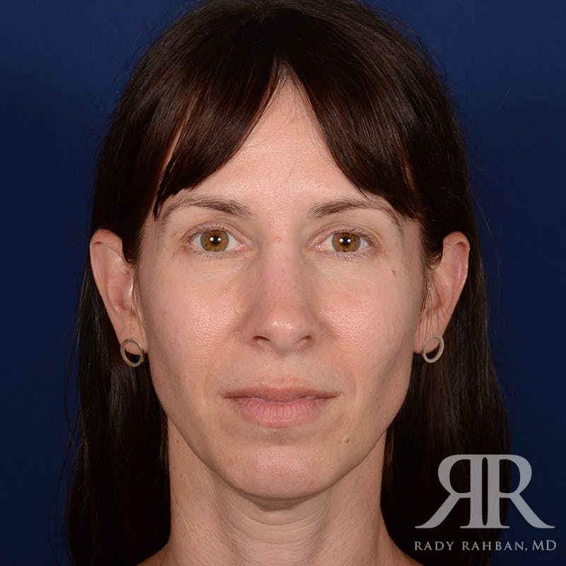 Facelift Before & After Gallery - Patient 165852 - Image 1