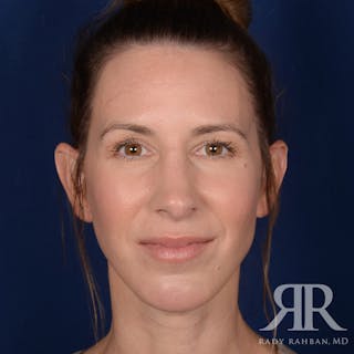 Facelift Before & After Gallery - Patient 165852 - Image 2
