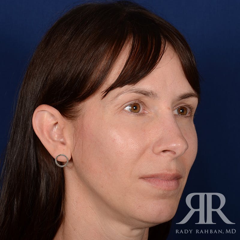 Facelift Before & After Gallery - Patient 165852 - Image 3