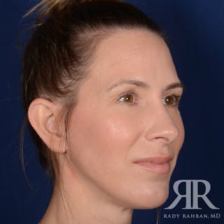 Facelift Before & After Gallery - Patient 165852 - Image 4