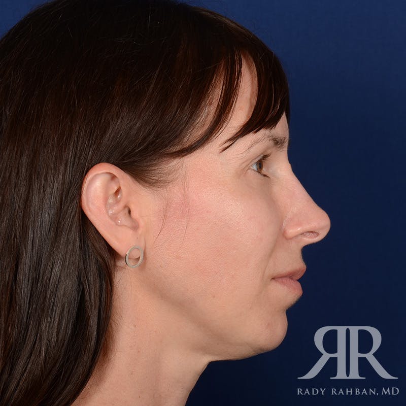 Facelift Before & After Gallery - Patient 165852 - Image 5