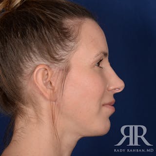 Facelift Before & After Gallery - Patient 165852 - Image 6