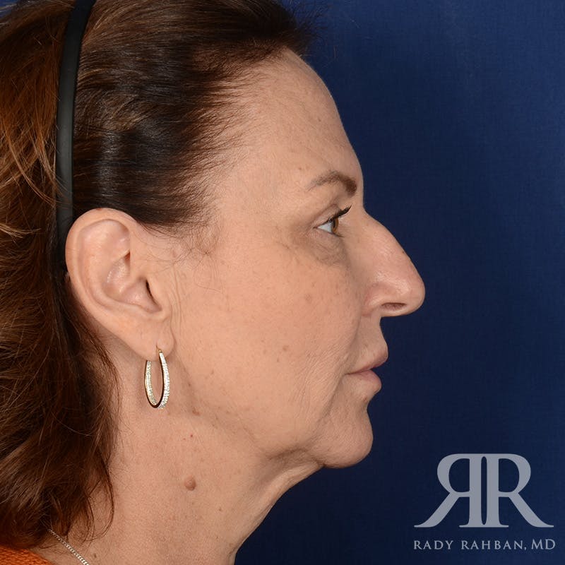 Facelift Before & After Gallery - Patient 306345 - Image 5