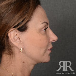 Facelift Before & After Gallery - Patient 306345 - Image 6