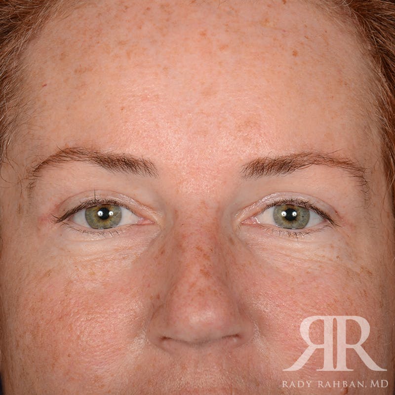 Browlift Before & After Gallery - Patient 995396 - Image 1