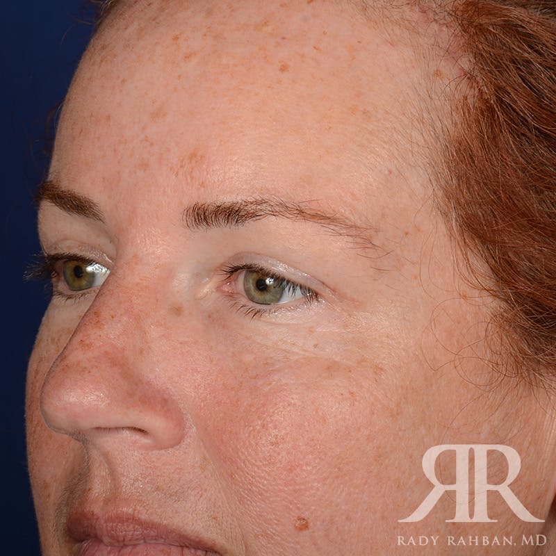 Browlift Before & After Gallery - Patient 995396 - Image 3
