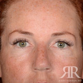 Browlift Before & After Gallery - Patient 995396 - Image 2