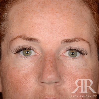 Browlift Before & After Gallery - Patient 995396 - Image 2