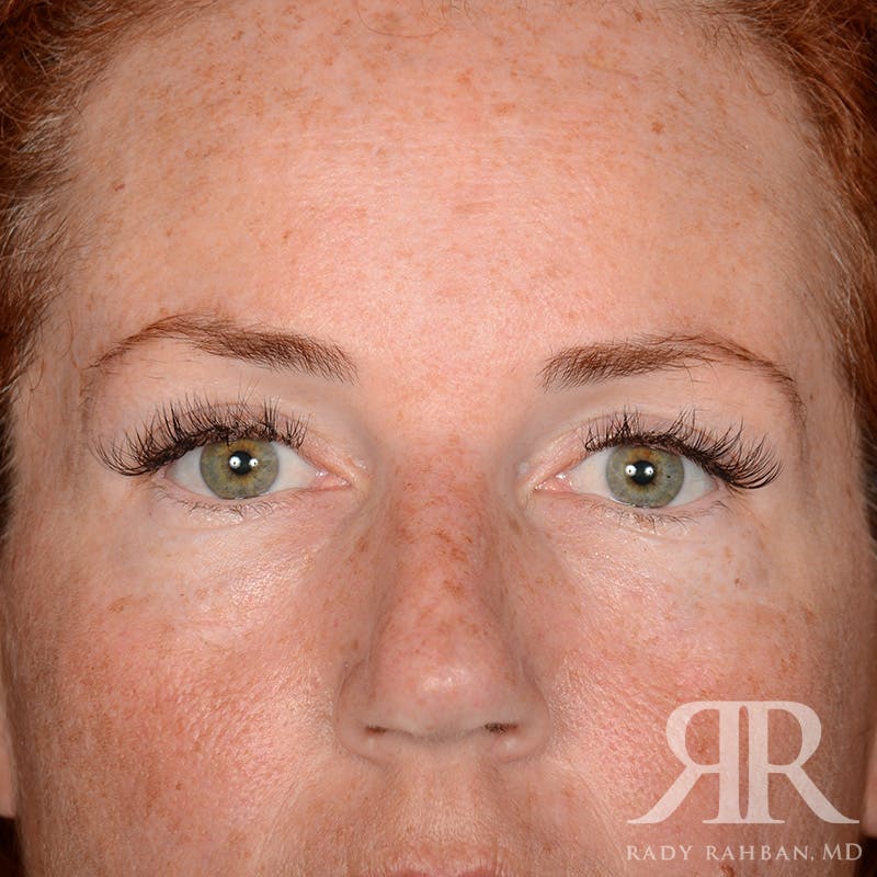 Browlift Before & After Gallery - Patient 995396 - Image 2
