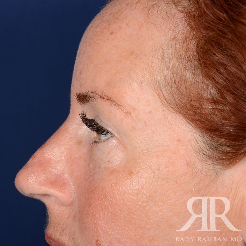 Browlift Before & After Gallery - Patient 995396 - Image 6