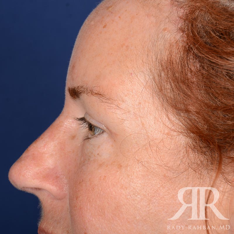 Browlift Before & After Gallery - Patient 995396 - Image 5