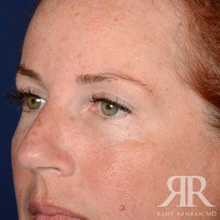 Browlift Before & After Gallery - Patient 995396 - Image 4