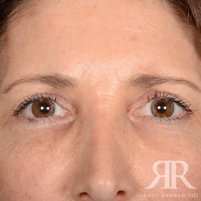 Browlift Before & After Gallery - Patient 932527 - Image 1