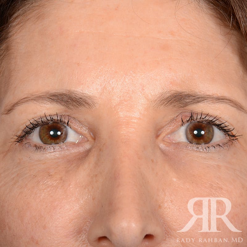 Browlift Before & After Gallery - Patient 932527 - Image 1
