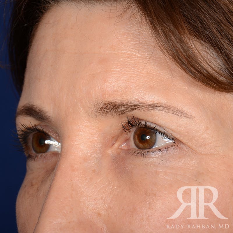 Browlift Before & After Gallery - Patient 932527 - Image 3