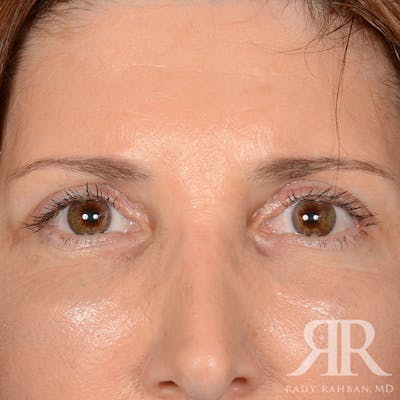 Browlift Before & After Gallery - Patient 932527 - Image 2