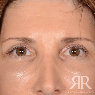 Browlift Before & After Gallery - Patient 932527 - Image 2