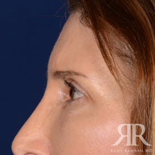 Browlift Before & After Gallery - Patient 932527 - Image 6