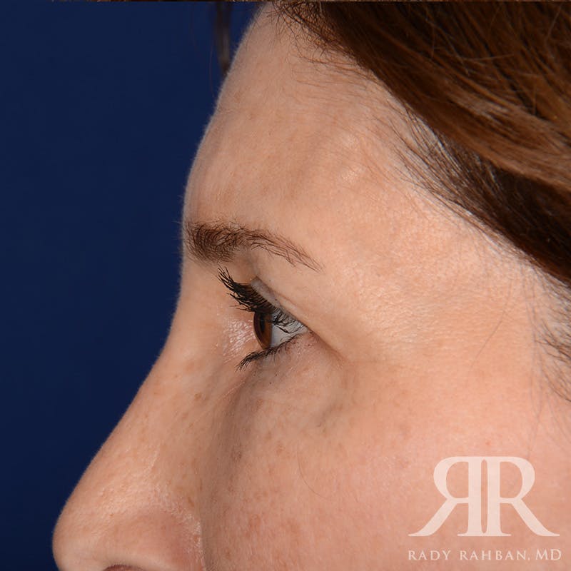 Browlift Before & After Gallery - Patient 932527 - Image 5