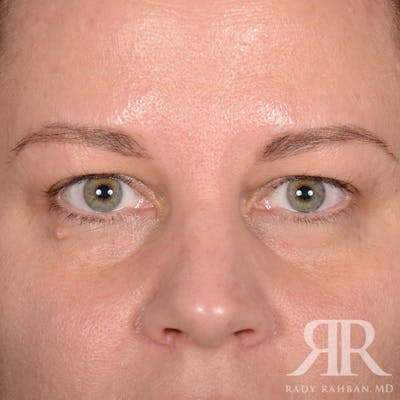 Browlift Before & After Gallery - Patient 229039 - Image 1