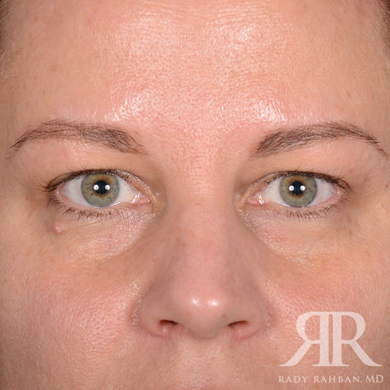 Browlift Before & After Gallery - Patient 229039 - Image 1